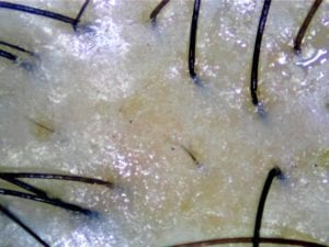 Example of hair loss caused by oily scalp