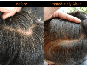 White or grey hair at young age? Reverse it to black with treatment! - Bee  Choo Ladies