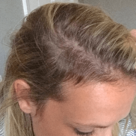 What is postpartum hair loss?