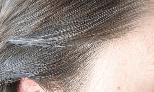 What are the causes of premature white hair
