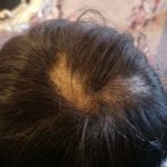Effective Hair Loss Treatment in Singapore (1)