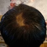 Effective Hair Loss Treatment in Singapore (2)