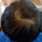 Effective Hair Loss Treatment in Singapore (3)