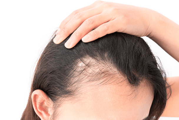 Female hair thinning at the crown and how to deal with it effectively in  Singapore - Bee Choo Ladies