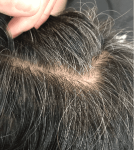 before white hair treatment in Singapore