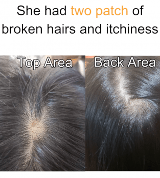 Effective Treatment to get rid of patchy hair loss and itchy scalp