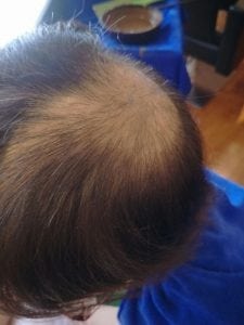 Effective Hair Loss Treatment in Singapore (trixie2)