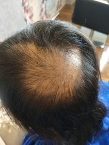 Effective Hair Loss Treatment in Singapore (trixie1)