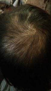 Effective Hair Loss Treatment in Singapore (trixie4)