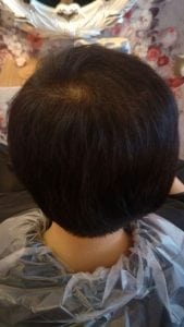 Effective Hair Loss Treatment in Singapore (trixie6)